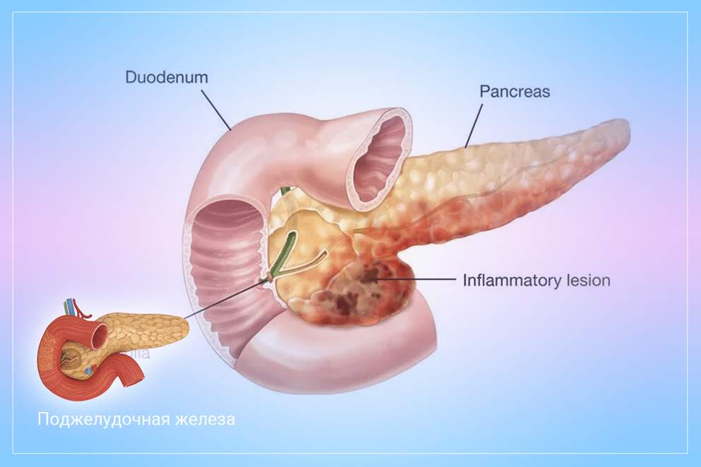 Панкреатит — что вызывает это заболевание?