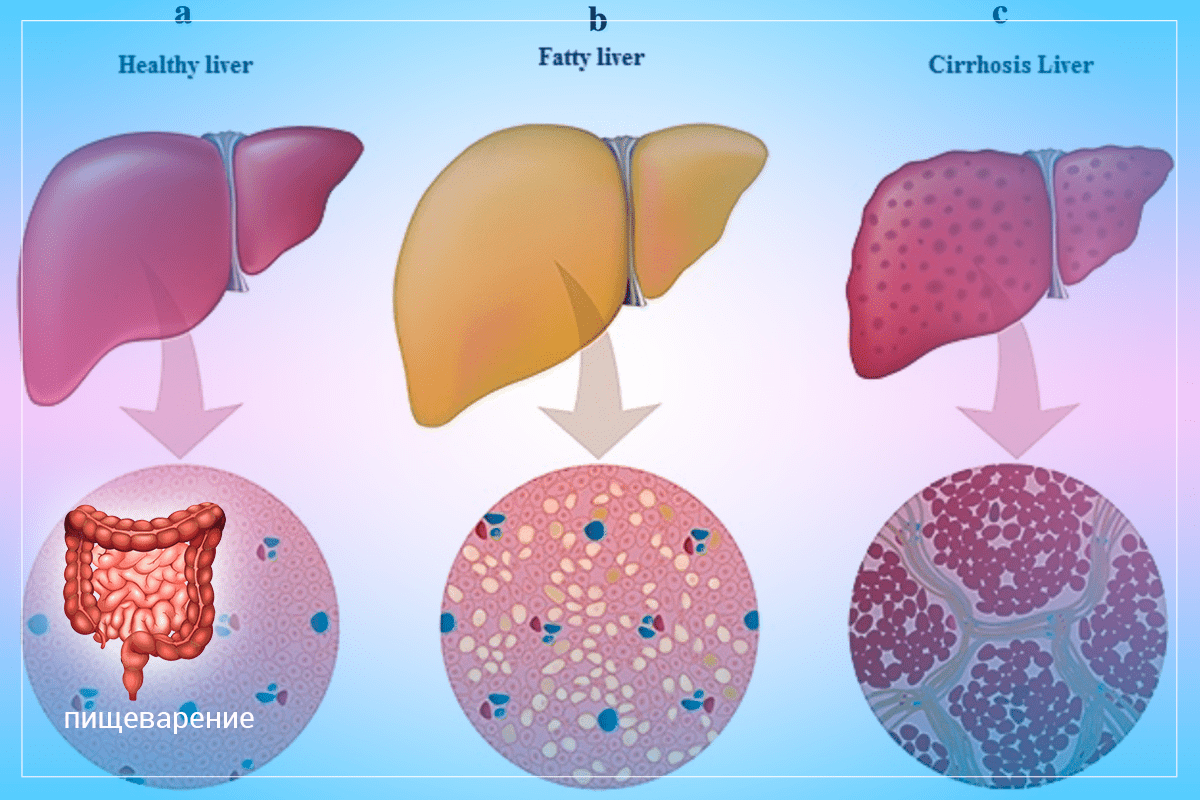 Симптомы жирового гепатоза печени